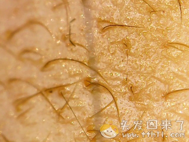 头皮检测仪记录小Y头发生长的图片（2018年10月15日）图片 No.11