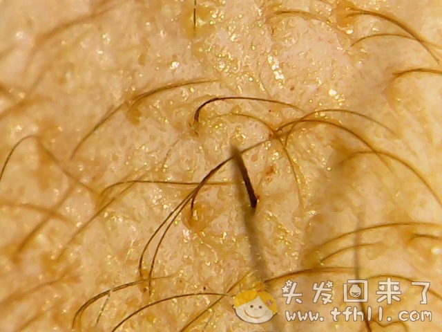 头皮检测仪记录小Y头发生长的图片（2018年10月15日）图片 No.12