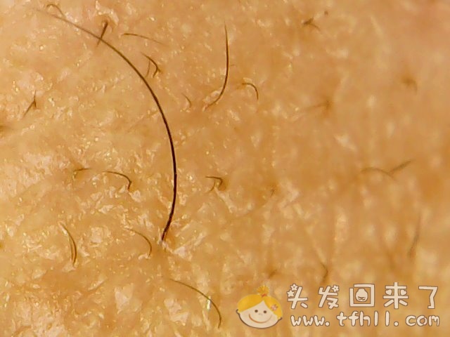 头皮检测仪记录小Y头发生长的图片（2018年10月15日）图片 No.13