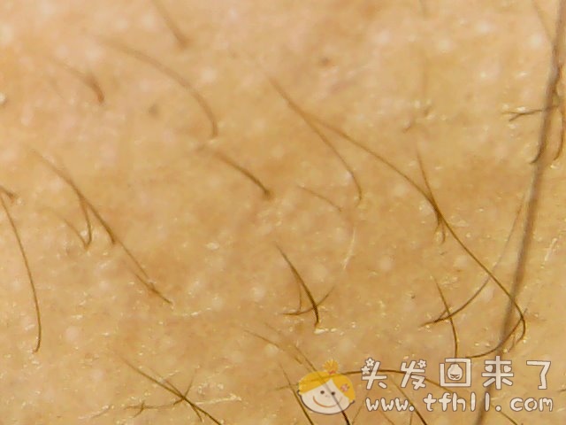 头皮检测仪记录小Y头发生长的图片（2018年12月23日）图片 No.1