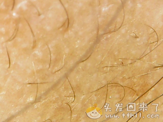 头皮检测仪记录小Y头发生长的图片（2018年12月23日）图片 No.2