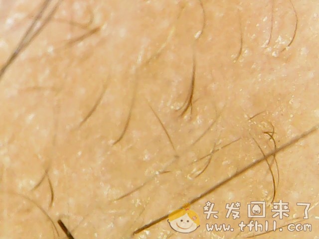 头皮检测仪记录小Y头发生长的图片（2018年12月23日）图片 No.3