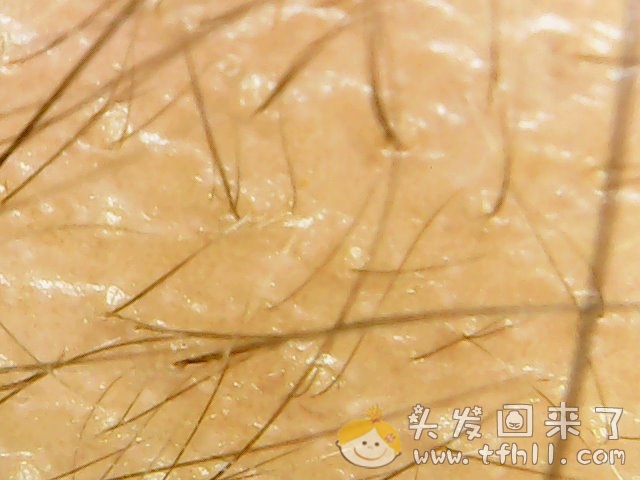 头皮检测仪记录小Y头发生长的图片（2018年12月23日）图片 No.4