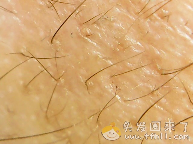头皮检测仪记录小Y头发生长的图片（2018年12月23日）图片 No.6