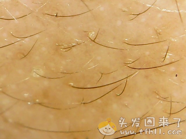 头皮检测仪记录小Y头发生长的图片（2018年12月23日）图片 No.7
