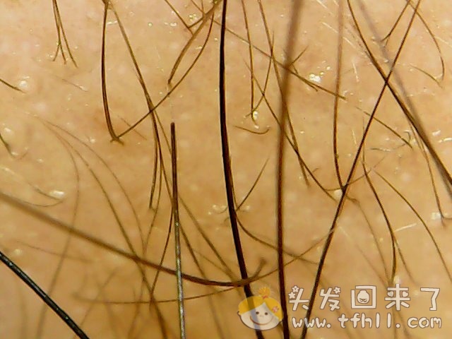 头皮检测仪记录小Y头发生长的图片（2018年12月23日）图片 No.8