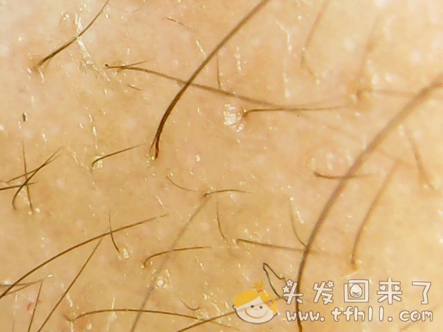头皮检测仪记录小Y头发生长的图片（2018年12月23日）图片 No.9