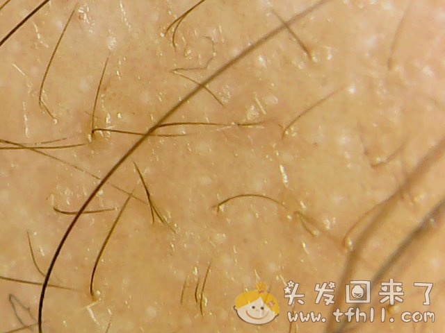 头皮检测仪记录小Y头发生长的图片（2018年12月23日）图片 No.10