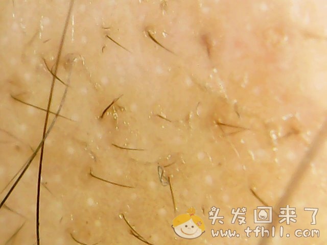 头皮检测仪记录小Y头发生长的图片（2018年12月23日）图片 No.11