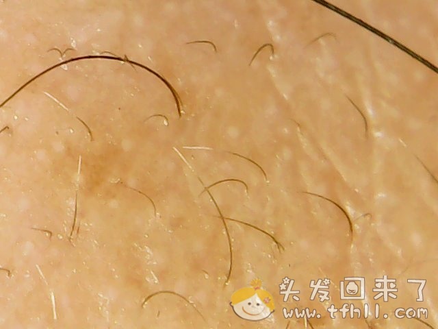 头皮检测仪记录小Y头发生长的图片（2018年12月23日）图片 No.12