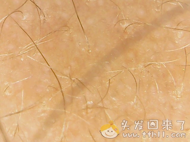 头皮检测仪记录小Y头发生长的图片（2019年3月27日）图片 No.2