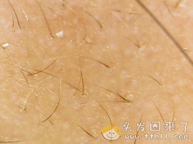 头皮检测仪记录小Y头发生长的图片（2019年3月27日）图片 No.3