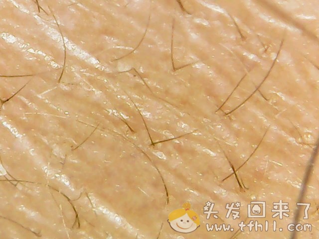 头皮检测仪记录小Y头发生长的图片（2019年3月27日）图片 No.4