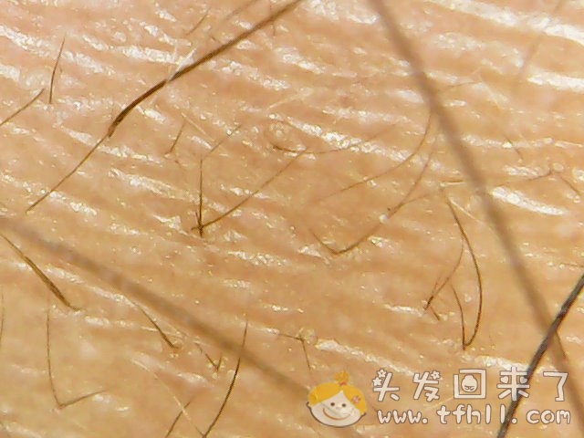 头皮检测仪记录小Y头发生长的图片（2019年3月27日）图片 No.5