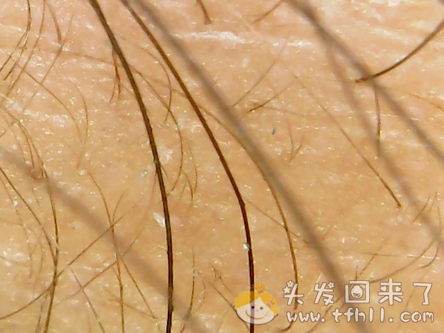 头皮检测仪记录小Y头发生长的图片（2019年3月27日）图片 No.6