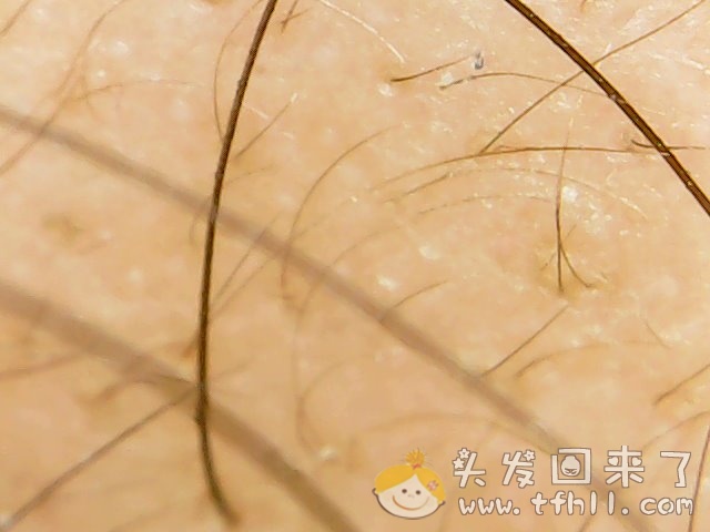 头皮检测仪记录小Y头发生长的图片（2019年3月27日）图片 No.7