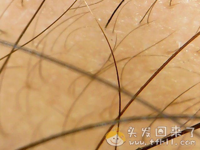 头皮检测仪记录小Y头发生长的图片（2019年3月27日）图片 No.8