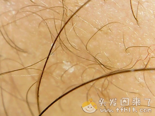 头皮检测仪记录小Y头发生长的图片（2019年3月27日）图片 No.9