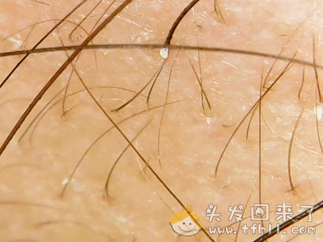头皮检测仪记录小Y头发生长的图片（2019年3月27日）图片 No.10
