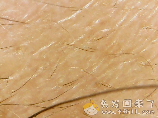 头皮检测仪记录小Y头发生长的图片（2019年3月27日）图片 No.11