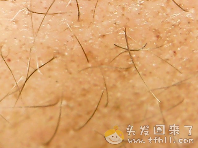 重新买了一支微针，这次买的是滚轮微针图片 No.3